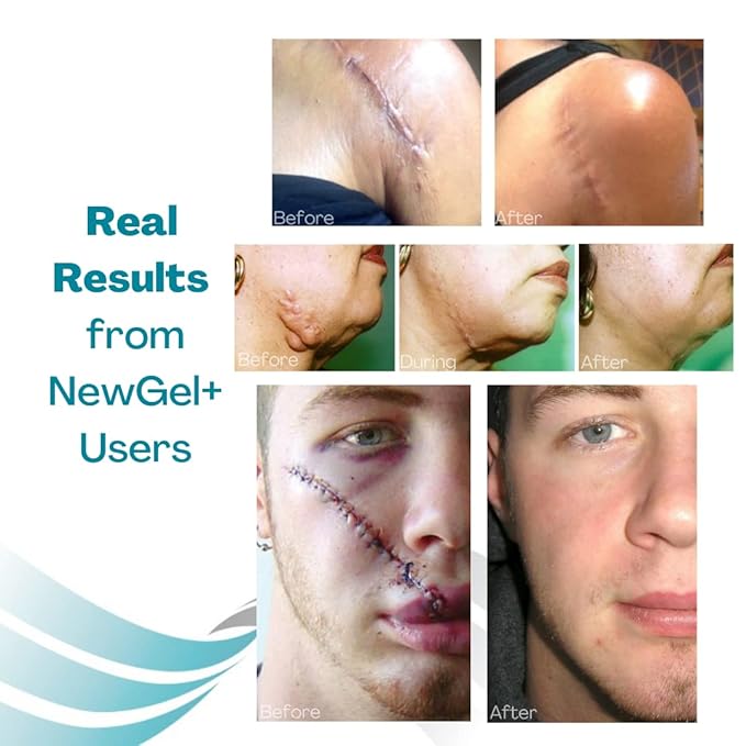 NewGel+ Advanced Silicone Scar Treatment Sheeting 1" x 6" Sheet (4 Count)