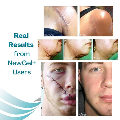 NewGel+ Advanced Silicone Scar Treatment Sheeting 1" x 6" Sheet (4 Count)