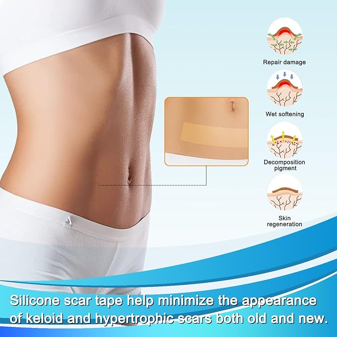 Medical Grade Silicone Scar Tape (1.6" x 157" - 4M) Professional