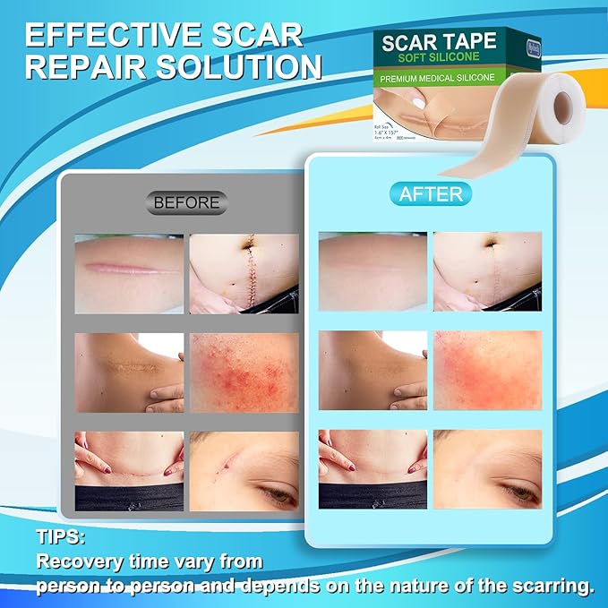 Medical Grade Silicone Scar Tape (1.6" x 157" - 4M) Professional
