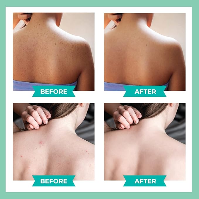 3 Pack Back Acne Treatment, Back 2% Salicylic