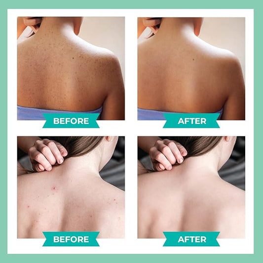 3 Pack Back Acne Treatment, Back 2% Salicylic